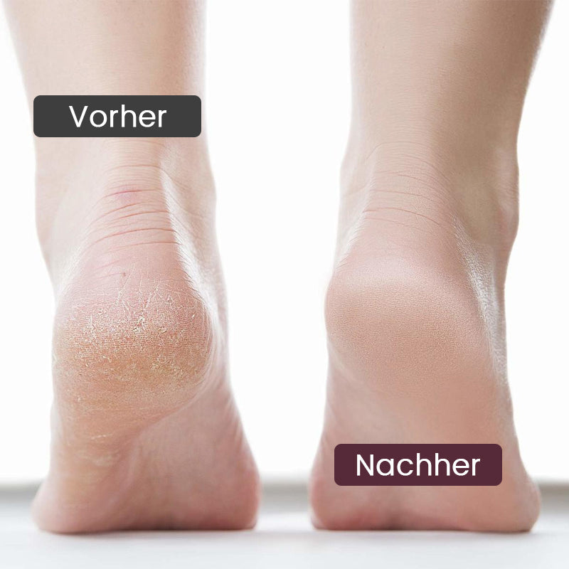 Elektrischer Peeling-Fußschleifer